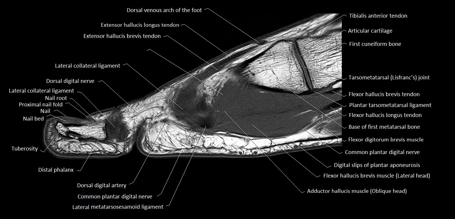 Hallux or big toe sagittal anatomy 3T MRI image 16.webp